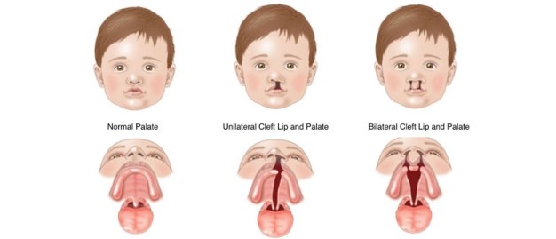 Cleft-Lip-and-Cleft-Palate-Formation-and-Treatment.jpg